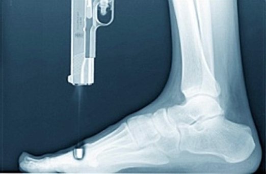 shoot-yourself-in-the-foot