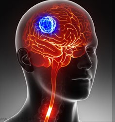 glioblastoma-multiforme (2)